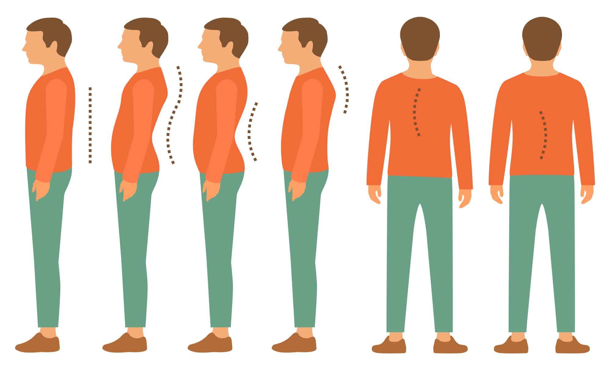 Hyperlordose lombaire : 9 exercices pour corriger le dos